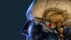 Cabergoline combined with low-dose pegvisomant effective in acromegaly Thumbnail