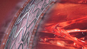 Very late stent thrombosis less with newer devices Thumbnail