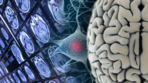 Amantadine accelerates recovery of cognition after traumatic brain injury Thumbnail