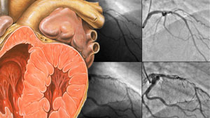 Timing of angiography/revascularization for non-STE ACS does not affect outcomes Thumbnail
