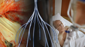 Vena cava filters cut pulmonary embolism fatalities in some categories of patients Thumbnail