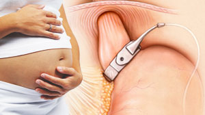 Bariatric surgery good for mom-to-be but not necessarily baby: study Thumbnail