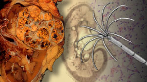Size matters when it comes to success of RFA for renal tumors Thumbnail