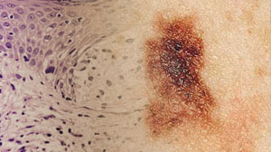 Vast majority of patients with thin melanomas alive at 20 years: study Thumbnail