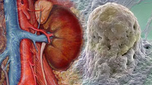 Autologous stem cells prevent acute rejection in renal transplantation Thumbnail