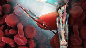 Paclitaxel-eluting balloon promising for femoropopliteal artery disease Thumbnail