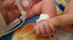 Less invasive protocol helps preemies breathe easier in limited resource settings Thumbnail