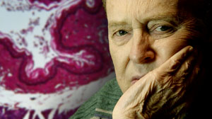 Prostate cancers detected by serial biopsy often clinically insignificant Thumbnail