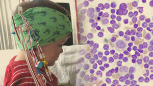 Curbed chemotherapy effective in Down Syndrome leukemia Thumbnail