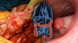 No benefit adding cetuximab to chemo after colon cancer resection Thumbnail