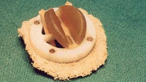 Maze procedure improves some outcomes of valve replacement in AF patients Thumbnail