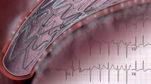 PCI outcomes in AF patients similar with different stent types Thumbnail