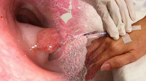 Adjuvant cetuximab improves some outcomes of high-risk rectal cancer Thumbnail