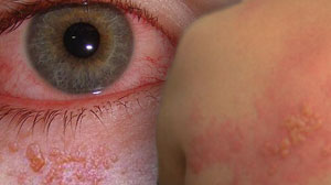 Uveitis incidence increases following herpes zoster Thumbnail