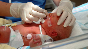 Early milk feeds safe, beneficial in preterm growth-restricted babies Thumbnail