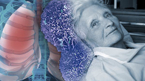 Skip the bevacizumab in elderly NSCLC patients Thumbnail