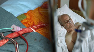Survival better with endovascular rather than open repair of aortic aneurysm Thumbnail