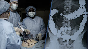Risk of small bowel obstruction less with laparoscopic than open surgery Thumbnail