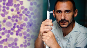 Induction with add-on cladribine improves survival in AML Thumbnail