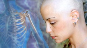 Naproxen lessens pegfilgrastim-induced bone pain Thumbnail