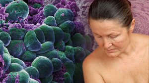 Cardiotoxicity partly offsets benefit of trastuzumab in HER2+ breast cancer Thumbnail