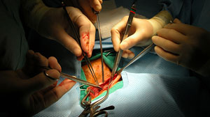 Pros and cons of conventional vs eversion CEA balance out over long term Thumbnail