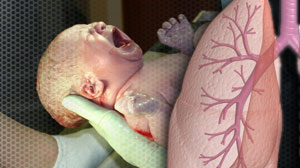 Antenatal steroids no benefit in late preterm neonates Thumbnail