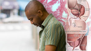 Intermittent androgen deprivation works in advanced prostate cancer: study Thumbnail