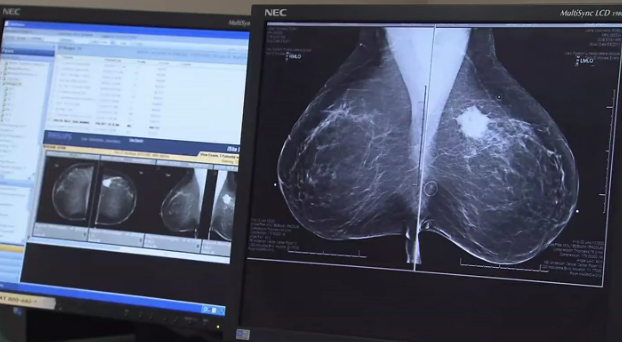 Better Outcomes for Older Women after Receiving Whole Breast Irradiation Compared to Brachytherapy Thumbnail