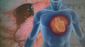 Risk/benefit of anticoagulation generally neutral in AF with GI ulcer Thumbnail