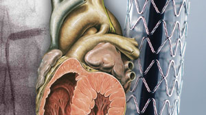 New meta-analysis confirms benefits of radial approach for PCI Thumbnail