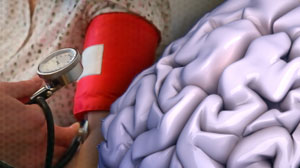 Lower BP guards against brain bleeds related to antithrombotic therapy Thumbnail