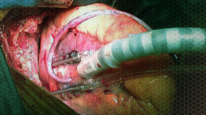 Outcomes similar with on-pump or off-pump CABG in elderly patients Thumbnail