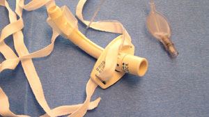 Early tracheostomy when needed after cardiac surgery has benefits Thumbnail