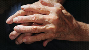 Hand surgery helpful for RA associated deformities Thumbnail