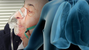 Indwelling pleural catheters no better than pleurodesis in palliating pleural effusion Thumbnail