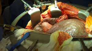 Liver transplant outcomes improving in Europe Thumbnail