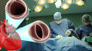 Simplified approach effective in aortic valve replacement Thumbnail