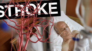 Post-stroke in-hospital statin therapy linked to better outcomes Thumbnail