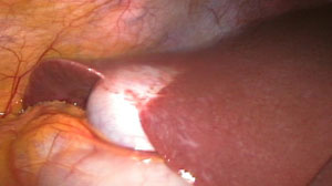 Morbidity high after percutaneous cholecystostomy for acute cholecystitis Thumbnail