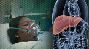 No surgery needed in most severe blunt liver injuries, experts say Thumbnail