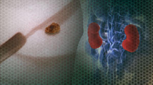 Ureteroscopy better than lithotripsy for distal ureteral stones Thumbnail