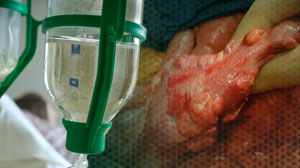 Younger patients with colon cancer benefit from adjuvant chemotherapy Thumbnail