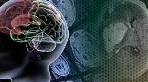No increased risk of intracerebral hemorrhage with statin use Thumbnail