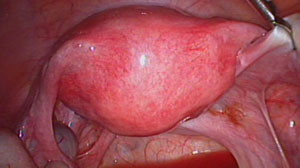 Diagnostic hysteroscopy safe in women with endometrial cancer Thumbnail