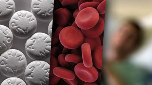 MI prevention with aspirin carries heavy ‘real-world’ bleeding risk Thumbnail