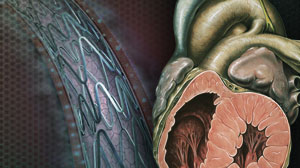 Ranolazine may have a role in elective PCI, pilot study hints Thumbnail