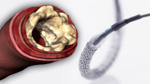 Post-conditioning during primary PCI reduces myocardial edema Thumbnail