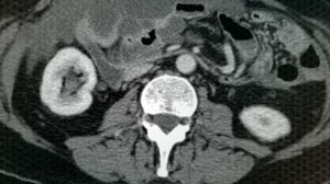 Combined modality approach effective for pseudomyxoma peritonei Thumbnail