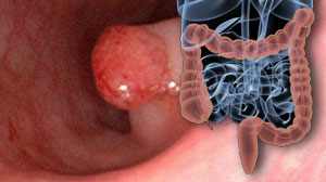 Cap-assisted colonoscopy offers few benefits over standard colonoscopy Thumbnail